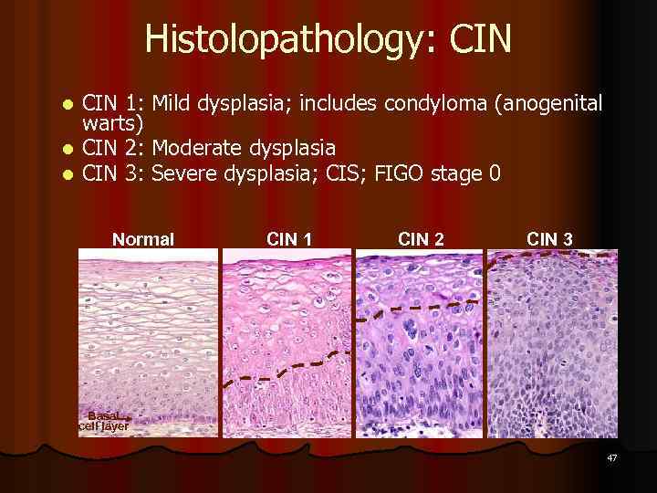 Histolopathology: CIN 1: Mild dysplasia; includes condyloma (anogenital warts) l CIN 2: Moderate dysplasia