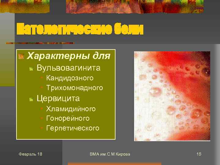 Патологические бели Характерны для Вульвовагинита • Кандидозного • Трихомонадного Цервицита • Хламидийного • Гонорейного