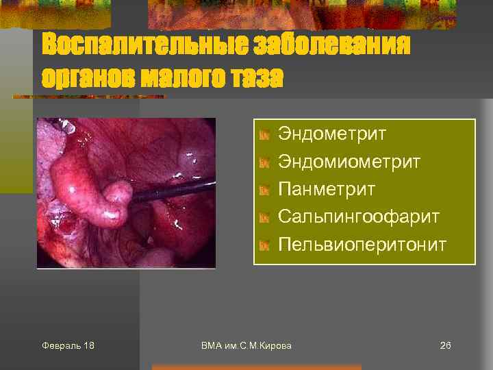 Воспалительные заболевания органов малого таза Эндометрит Эндомиометрит Панметрит Сальпингоофарит Пельвиоперитонит Февраль 18 ВМА им.