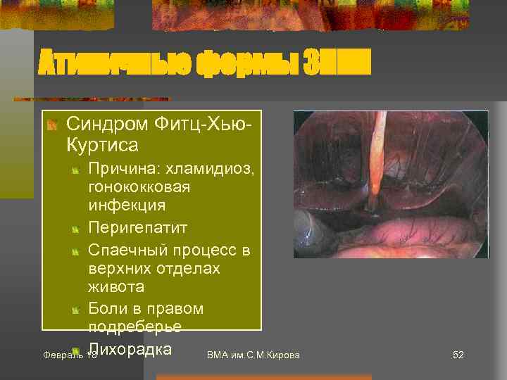 Атипичные формы ЗППП Синдром Фитц-Хью. Куртиса Причина: хламидиоз, гонококковая инфекция Перигепатит Спаечный процесс в
