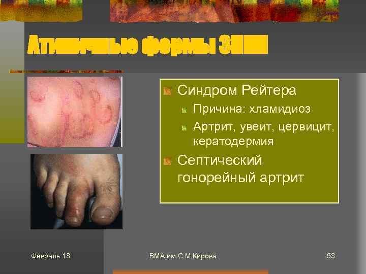 Атипичные формы ЗППП Синдром Рейтера Причина: хламидиоз Артрит, увеит, цервицит, кератодермия Септический гонорейный артрит