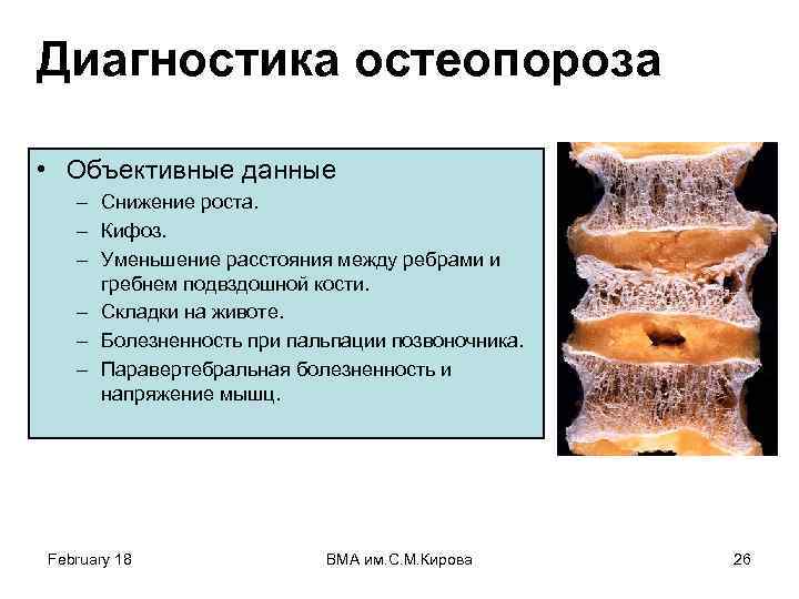 Диагностика остеопороза • Объективные данные – Снижение роста. – Кифоз. – Уменьшение расстояния между