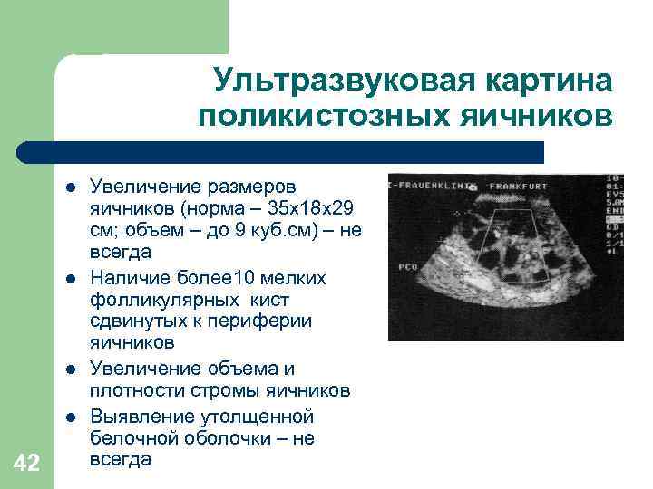 Ультразвуковая картина поликистозных яичников l l 42 Увеличение размеров яичников (норма – 35 х18