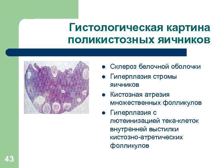 Гистологическая картина поликистозных яичников l l 43 Склероз белочной оболочки Гиперплазия стромы яичников Кистозная