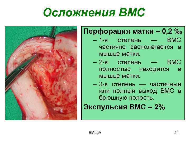 Осложнения ВМС Перфорация матки – 0, 2 ‰ – 1 -я степень — ВМС