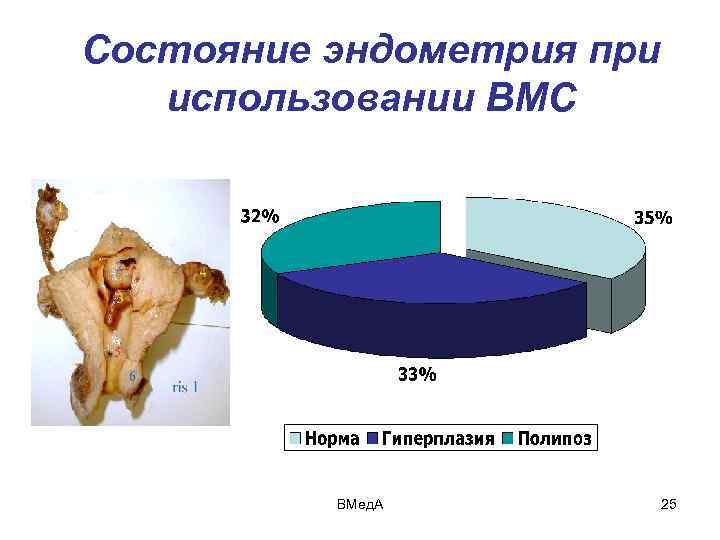 Состояние эндометрия при использовании ВМС ВМед. А 25 