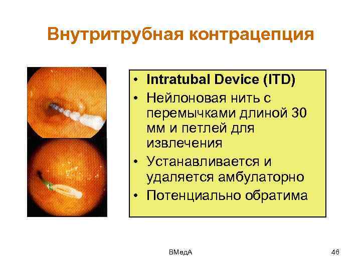 Внутритрубная контрацепция • Intratubal Device (ITD) • Нейлоновая нить с перемычками длиной 30 мм