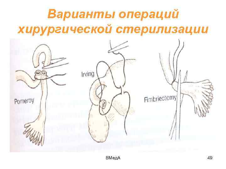 Варианты операций хирургической стерилизации ВМед. А 49 