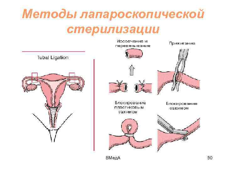 Методы лапароскопической стерилизации ВМед. А 50 