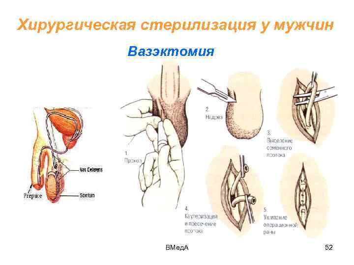 Вазэктомия что это. Хирургическая стерилизация вазэктомия. Вазэктомия схема операции. Хирургический метод контрацепции (стерилизация) мужская. Мужская стерилизация вазэктомия.