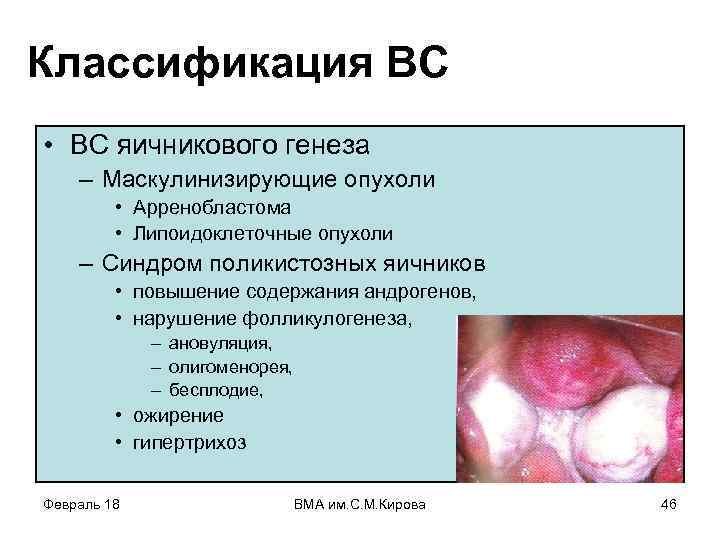 Классификация ВС • ВС яичникового генеза – Маскулинизирующие опухоли • Арренобластома • Липоидоклеточные опухоли