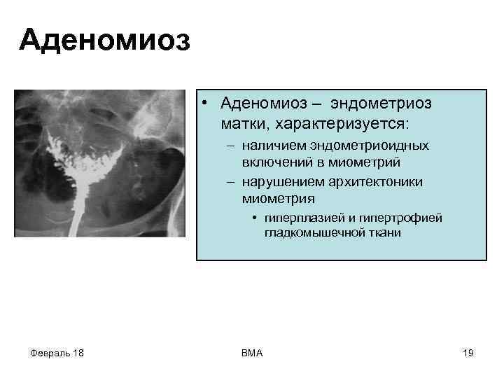 Аденомиоз • Аденомиоз – эндометриоз матки, характеризуется: – наличием эндометриоидных включений в миометрий –