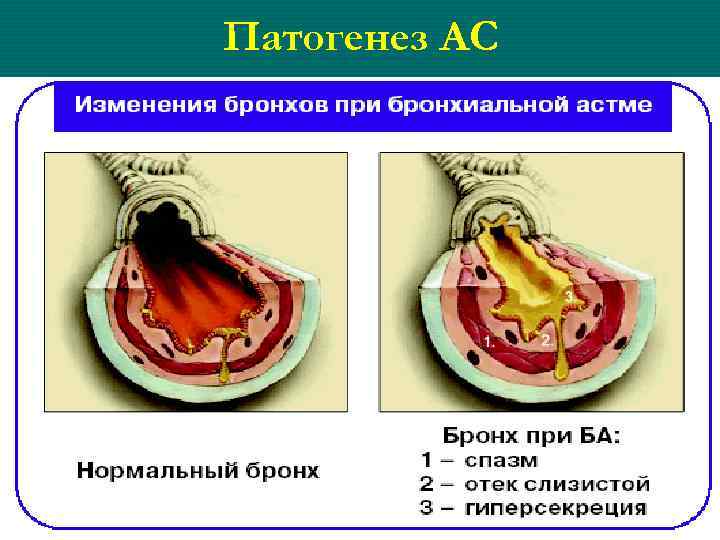 Патогенез АС 5 