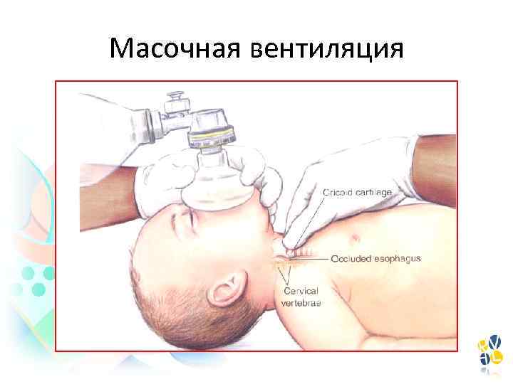 Масочная вентиляция 