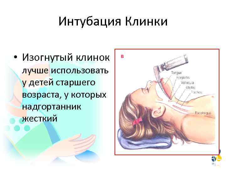 Интубация Клинки • Изогнутый клинок лучше использовать у детей старшего возраста, у которых надгортанник