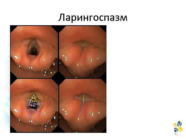 Ларингоспазм 