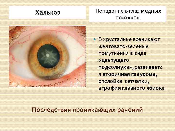 Халькоз Попадание в глаз медных осколков. В хрусталике возникают желтовато-зеленые помутнения в виде «цветущего