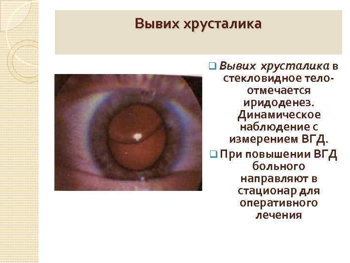 Вывих хрусталика q Вывих хрусталика в стекловидное телоотмечается иридоденез. Динамическое наблюдение с измерением ВГД.