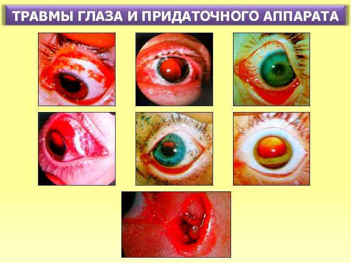 ТРАВМЫ ГЛАЗА И ПРИДАТОЧНОГО АППАРАТА 