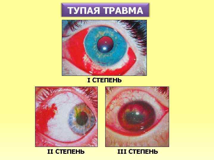 ТУПАЯ ТРАВМА I СТЕПЕНЬ III СТЕПЕНЬ 