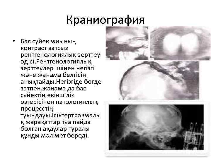 Краниография • Бас сүйек миының контраст затсыз рентгенологиялық зерттеу әдісі. Рентгенологиялық зерттеулер ішінен негізгі