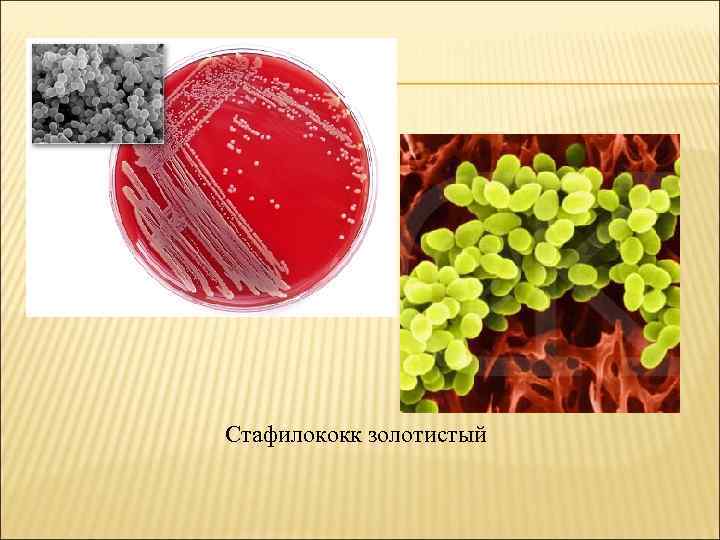 Стафилококк золотистый 