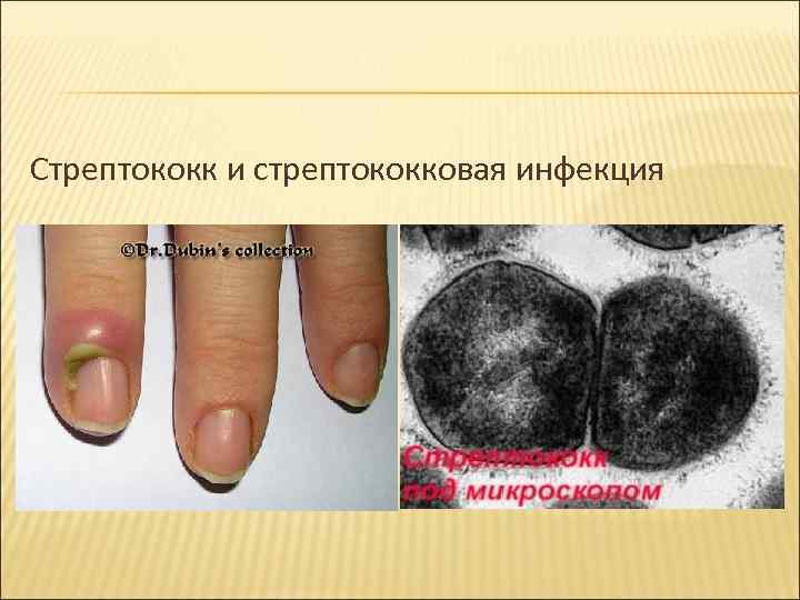 Стрептококк и стрептококковая инфекция 