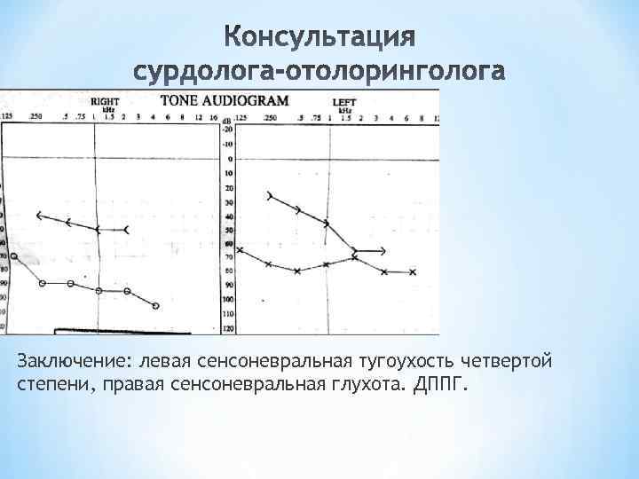 Заключение: левая сенсоневральная тугоухость четвертой степени, правая сенсоневральная глухота. ДППГ. 