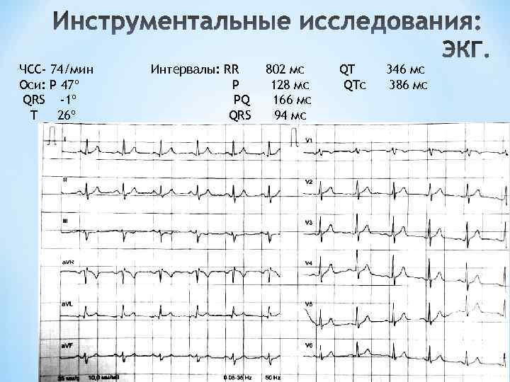 Смещение параметров qrs