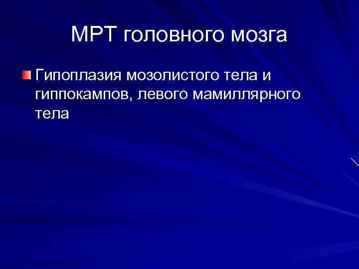 МРТ головного мозга Гипоплазия мозолистого тела и гиппокампов, левого мамиллярного тела 