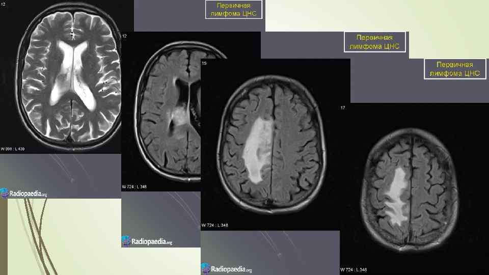 Нейроспид. Первичная лимфома головного мозга.