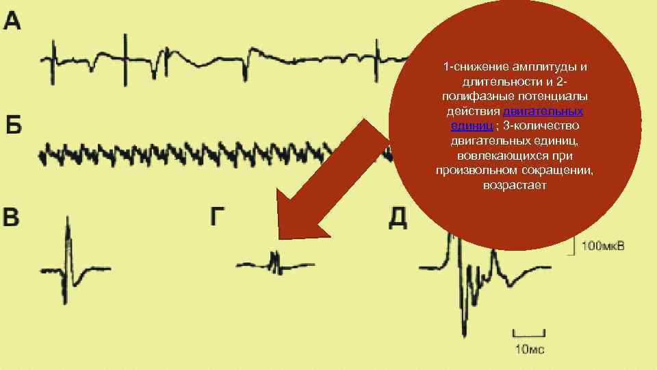 Уменьшение амплитуды. Полифазные потенциалы на ЭЭГ. Снижение амплитуды. Острые полифазные потенциалы на ЭЭГ.