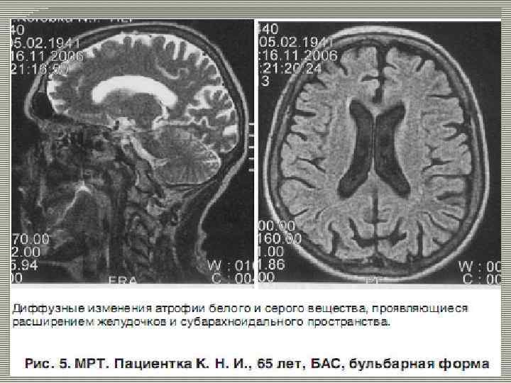 Инструментальные исследования Игольчатая ЭМГ Стимуляционная ЭМГ ТКМС МРТ Лабораторная диагностика: молекулярногенетический анализ гена СОД