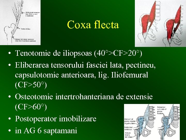 Coxa flecta • Tenotomie de iliopsoas (40°>CF>20°) • Eliberarea tensorului fasciei lata, pectineu, capsulotomie