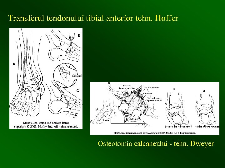 Transferul tendonului tibial anterior tehn. Hoffer Osteotomia calcaneului - tehn. Dweyer 