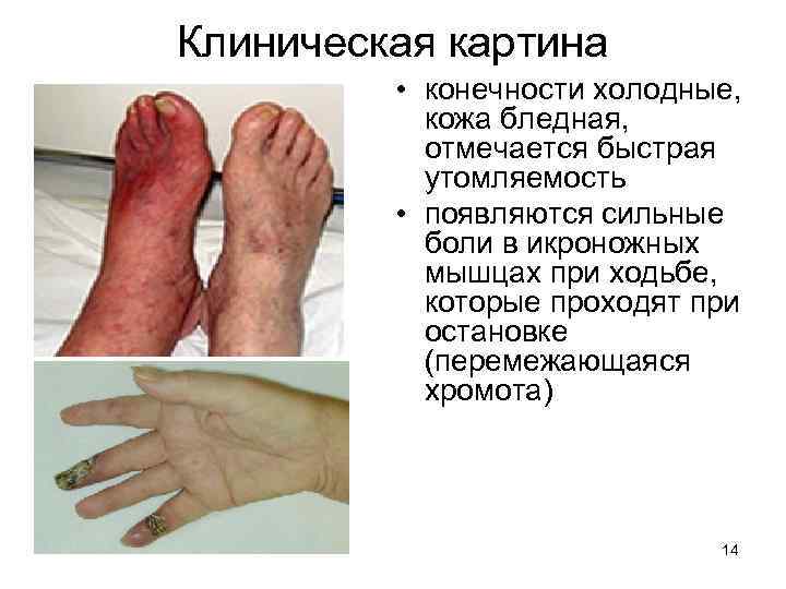 Клиническая картина • конечности холодные, кожа бледная, отмечается быстрая утомляемость • появляются сильные боли
