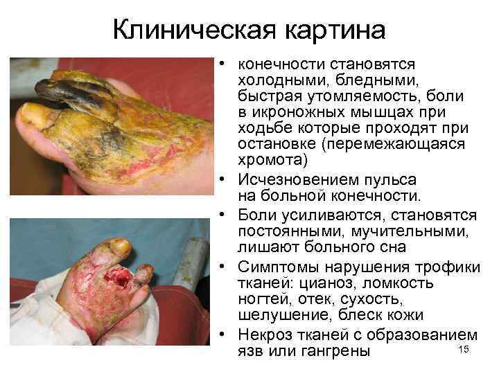 Клиническая картина • конечности становятся холодными, бледными, быстрая утомляемость, боли в икроножных мышцах при