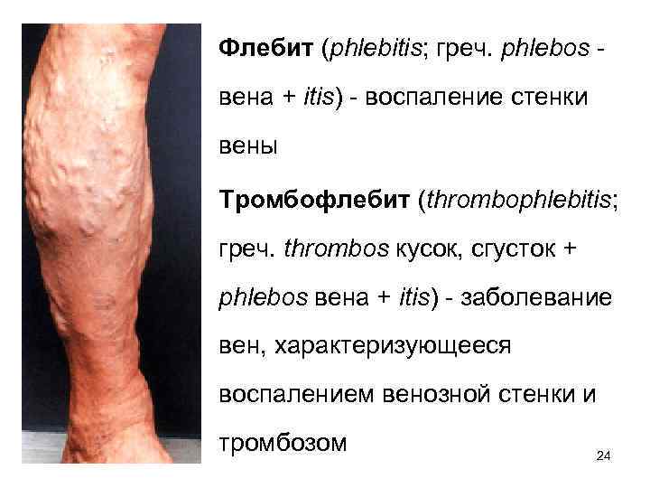 Флебит (phlebitis; греч. phlebos - вена + itis) - воспаление стенки вены Тромбофлебит (thrombophlebitis;