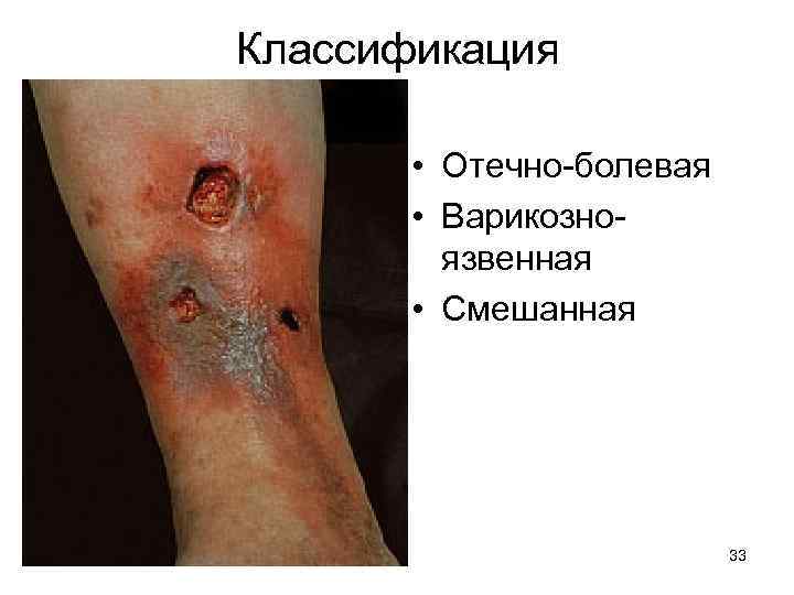 Классификация • Отечно-болевая • Варикозноязвенная • Смешанная 33 