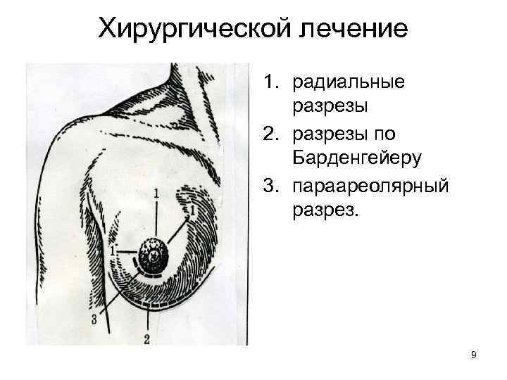 Хирургической лечение 1. радиальные разрезы 2. разрезы по Барденгейеру 3. параареолярный разрез. 9 