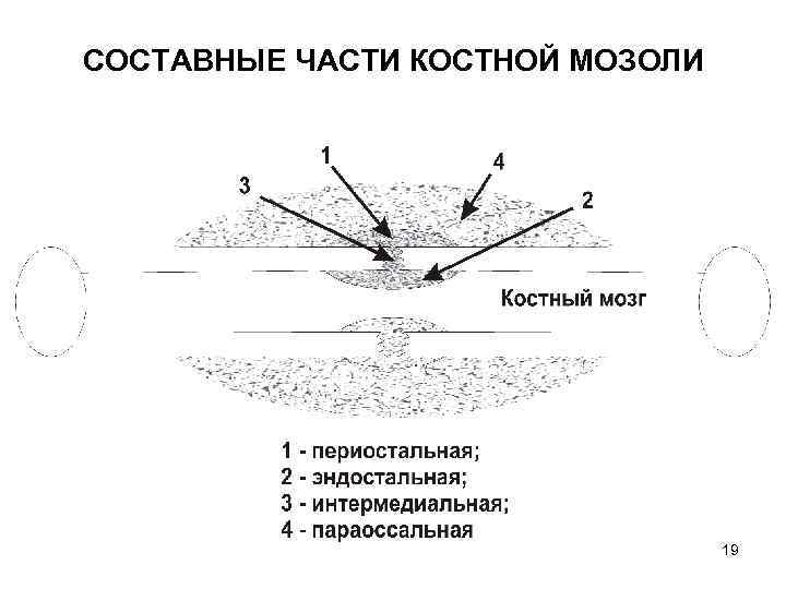 СОСТАВНЫЕ ЧАСТИ КОСТНОЙ МОЗОЛИ 19 