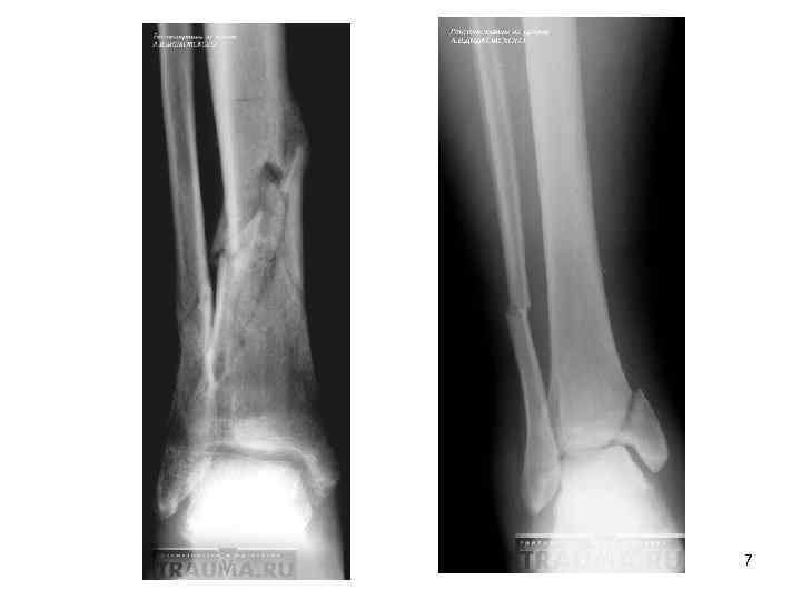Патологический перелом. Травматические и патологические переломы. Травматический перелом кости. Травматический закрытый перелом. Травматический перелом рентген.