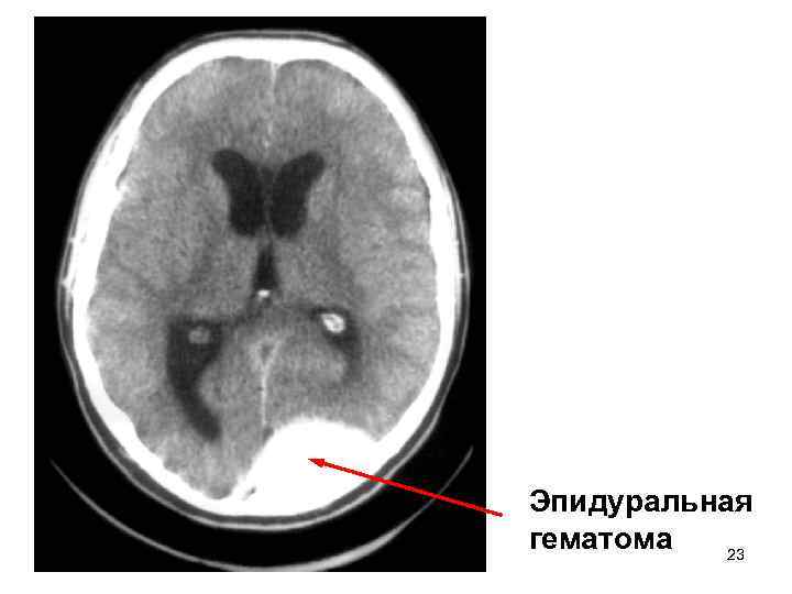 Эпидуральная гематома 23 