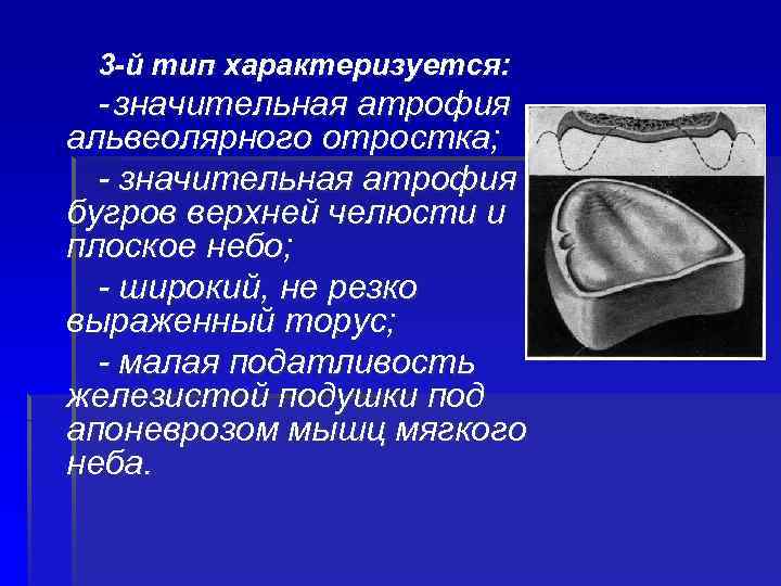 3 -й тип характеризуется: - значительная атрофия альвеолярного отростка; - значительная атрофия бугров верхней