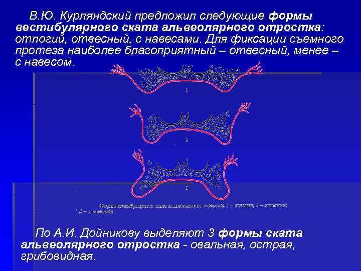 В. Ю. Курляндский предложил следующие формы вестибулярного ската альвеолярного отростка: отлогий, отвесный, с навесами.