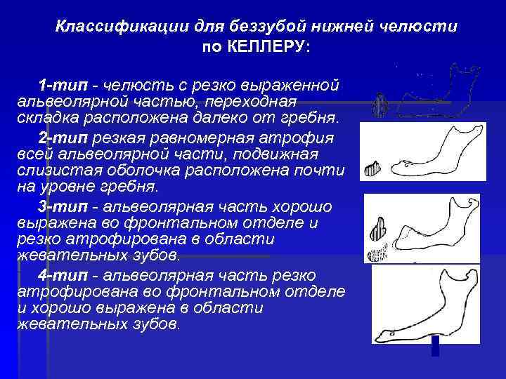 Классификации для беззубой нижней челюсти по КЕЛЛЕРУ: 1 -тип - челюсть с резко выраженной