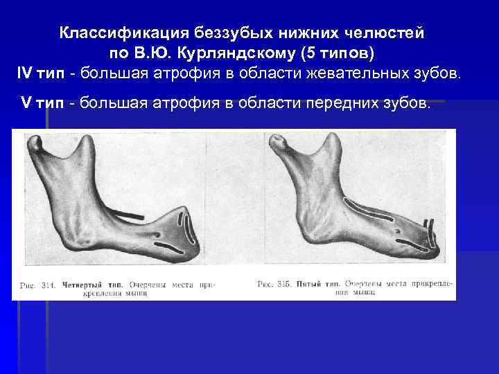 Классификация беззубых нижних челюстей по В. Ю. Курляндскому (5 типов) IV тип - большая