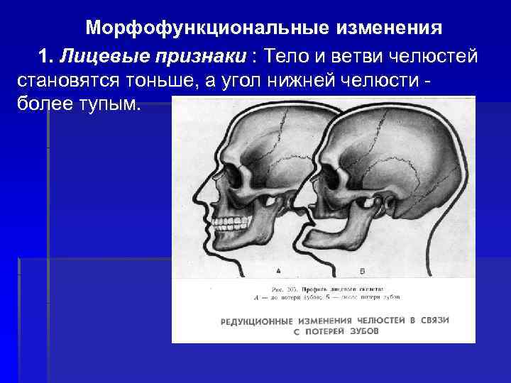 Морфофункциональные изменения 1. Лицевые признаки : Тело и ветви челюстей становятся тоньше, а угол