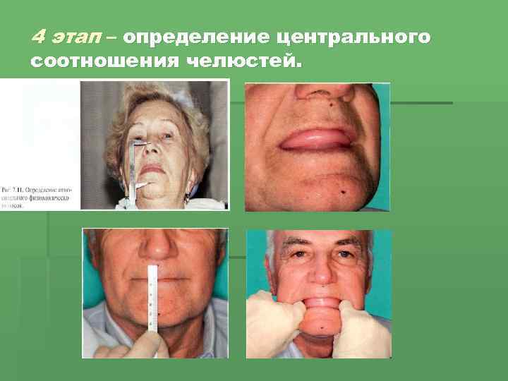4 этап – определение центрального соотношения челюстей. 
