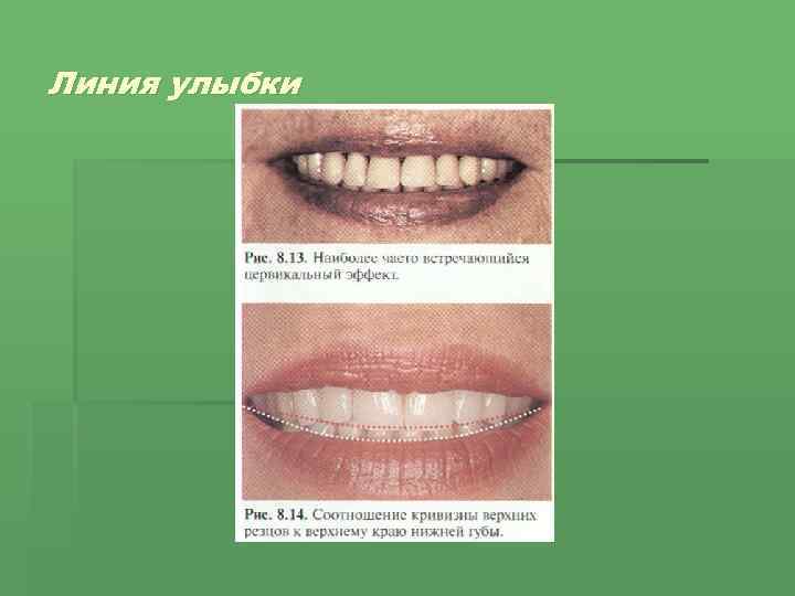 Линия улыбки 